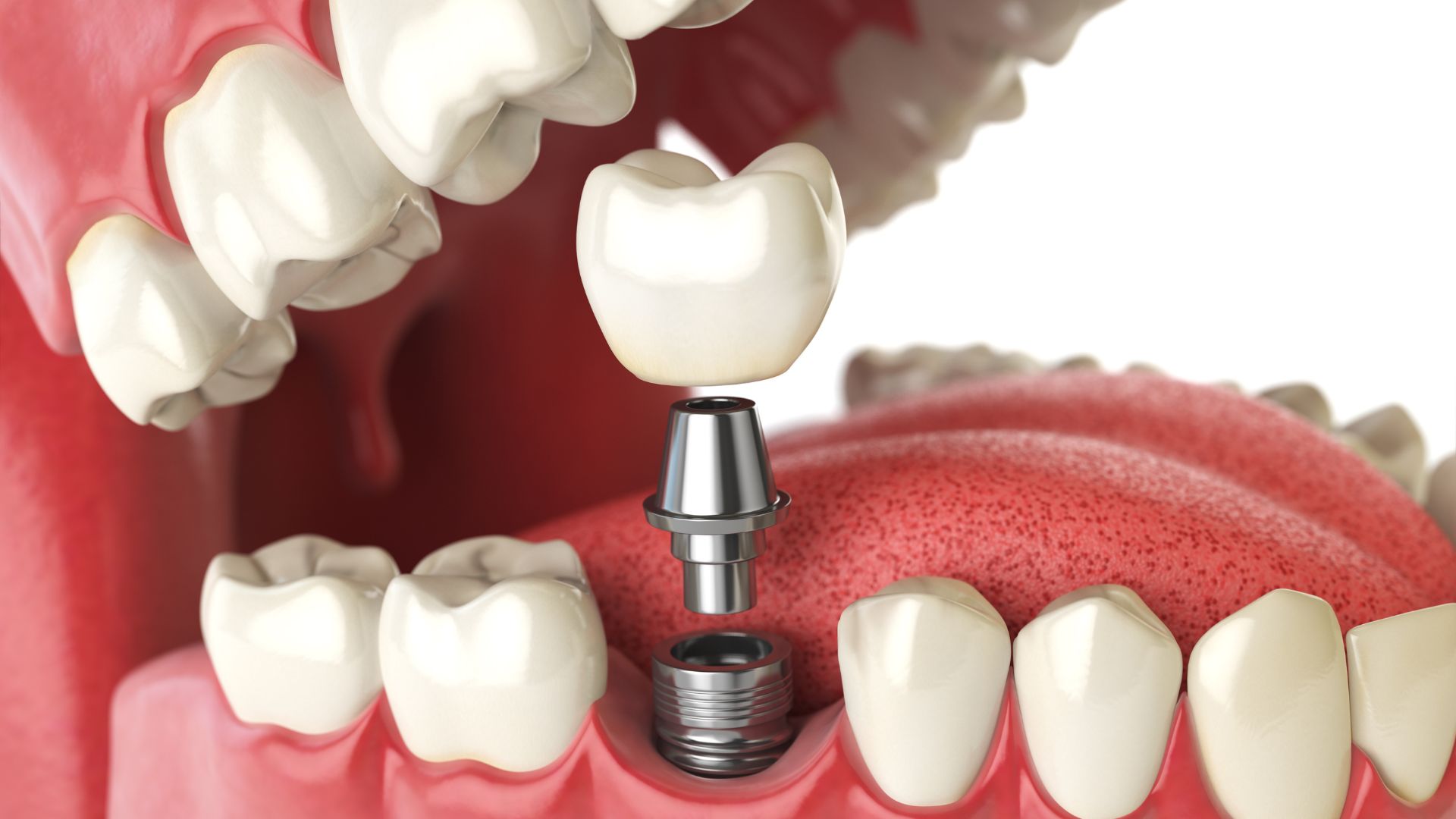 Bone Grafting for Dental Implants in Atlanta: Essential Techniques and Benefits for Successful Implantation